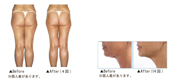 endermologieアライアンス